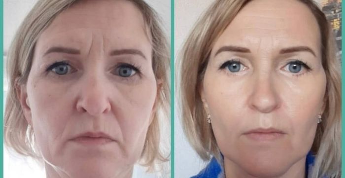 7D HIFU Treatment Facelift Wrinkle Removal Tampa St