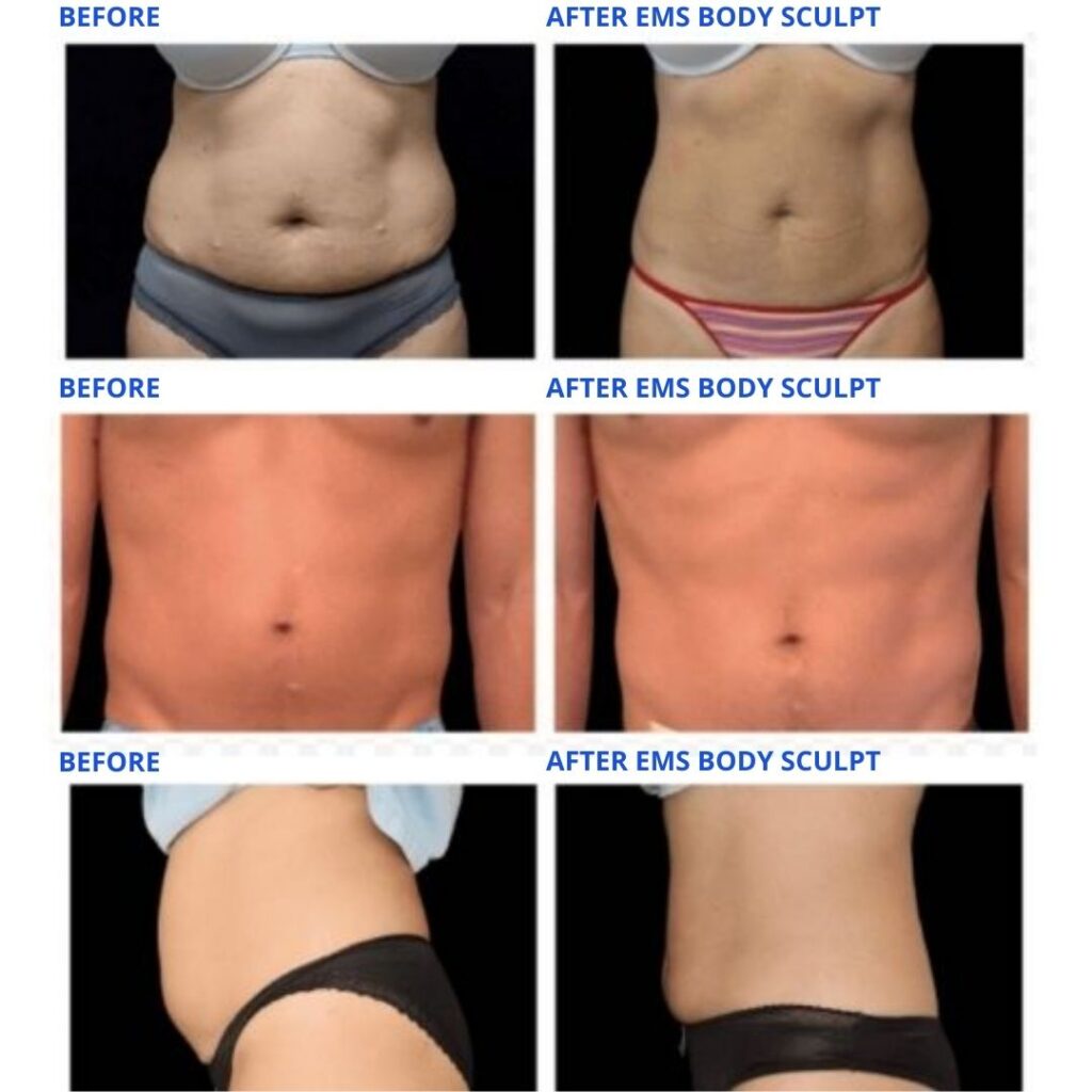 EMS Body Sculpt Treatment Florida