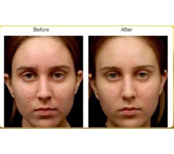 Dermaplanning treatment before and after image