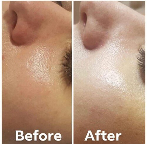 Microneedling RF Treatment Tampa